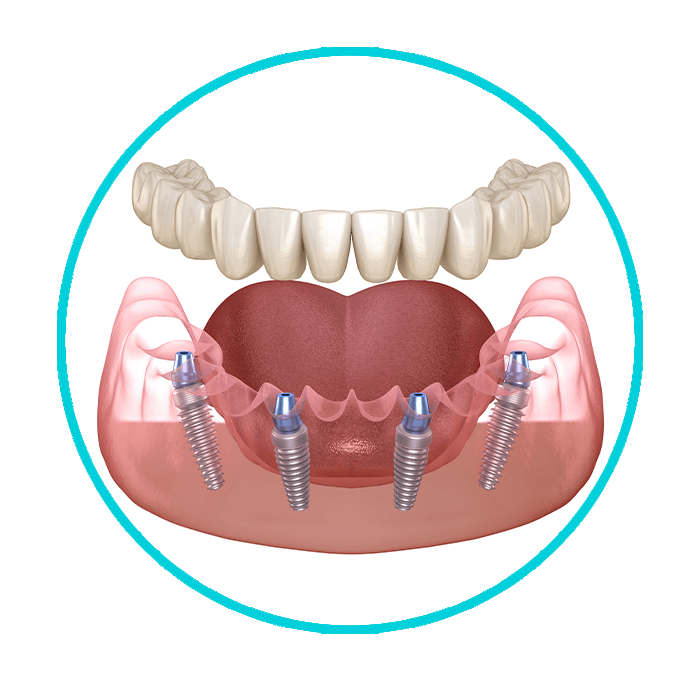 full mouth dental implants