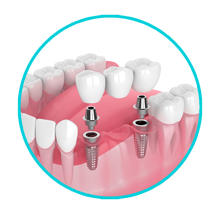 implant-supported dentures