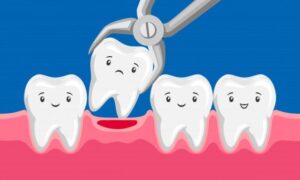 Cartoon tooth removed by forceps.